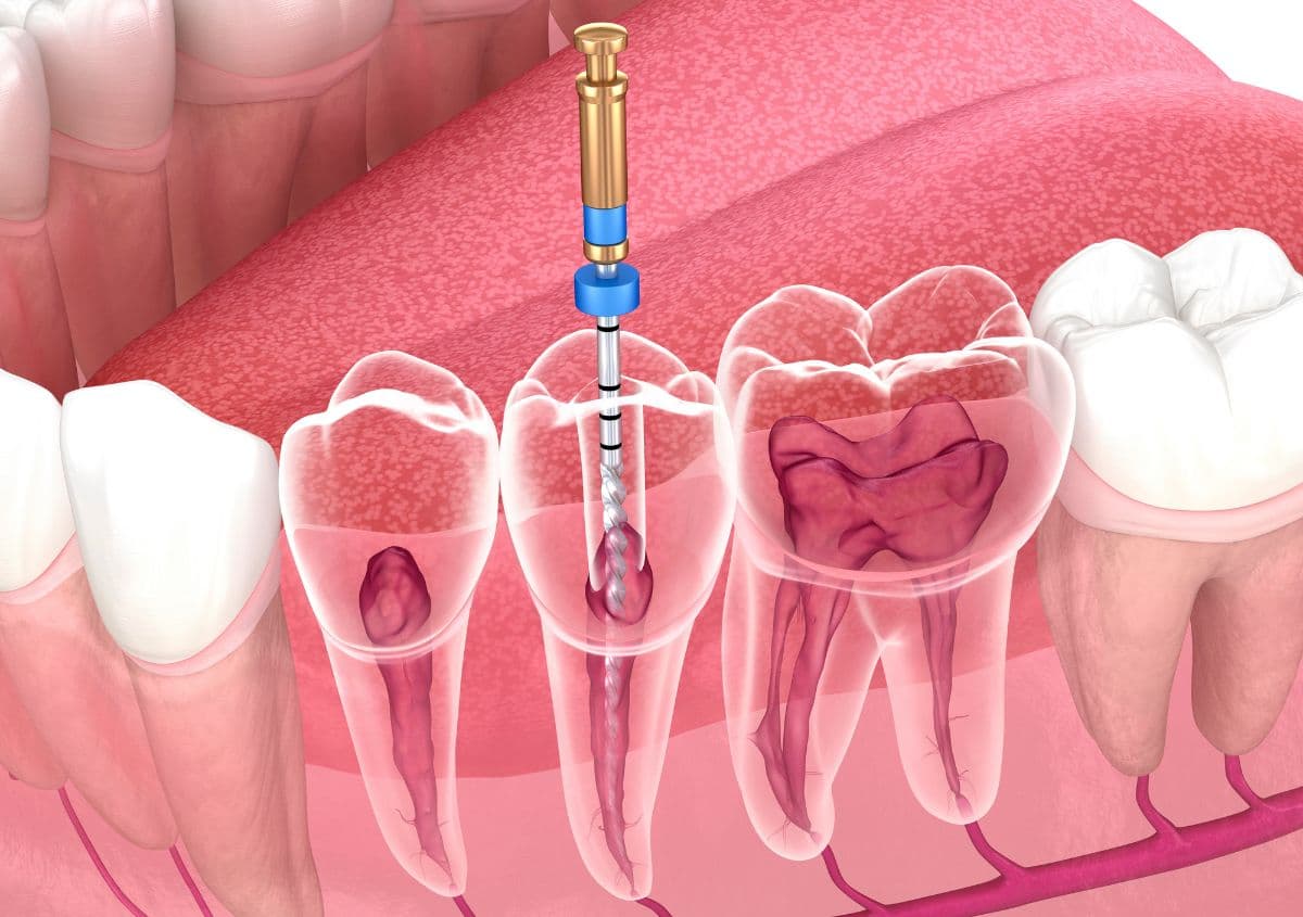 root canal near me conyers ga