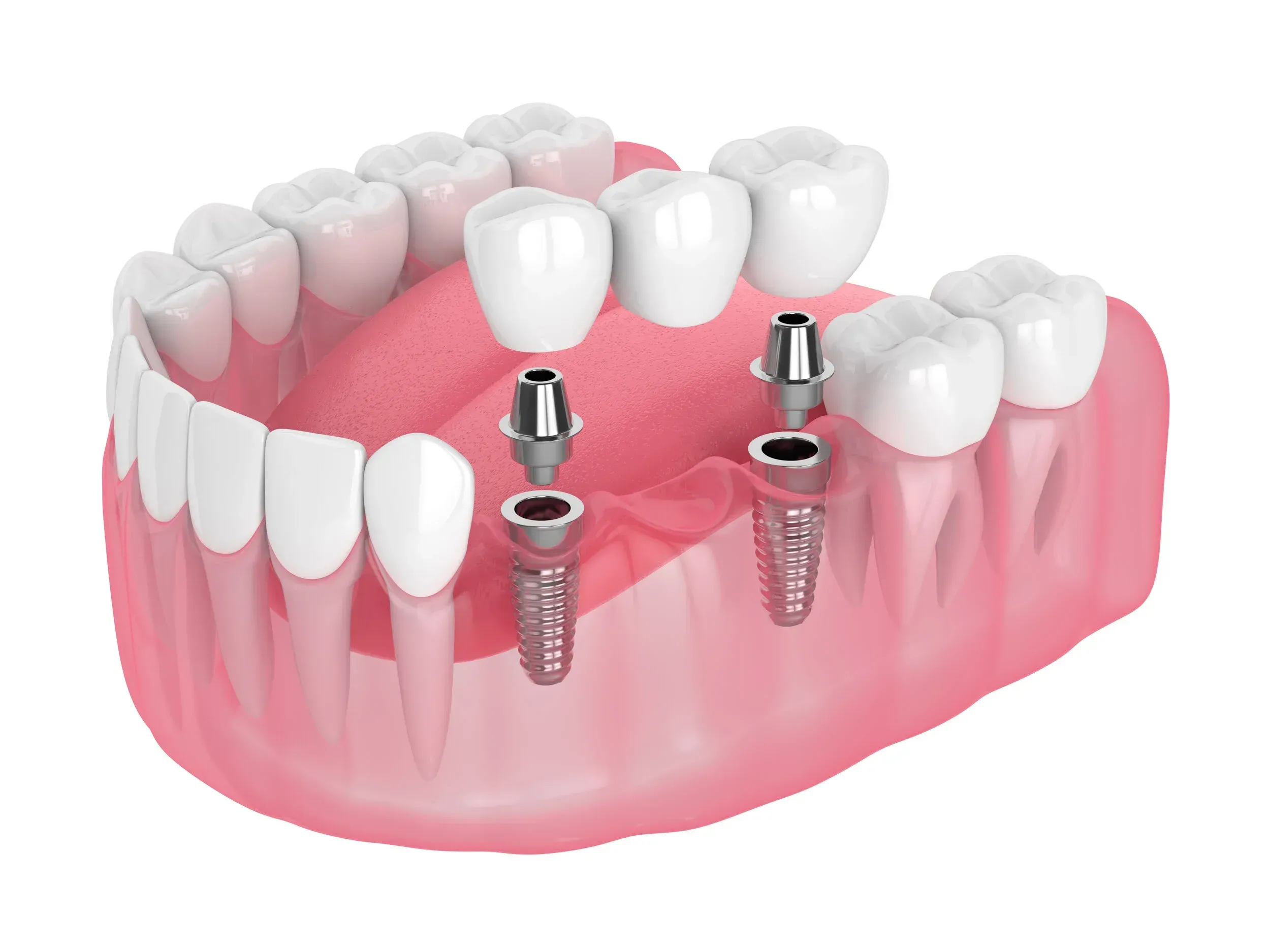 implant+bridge+illustration