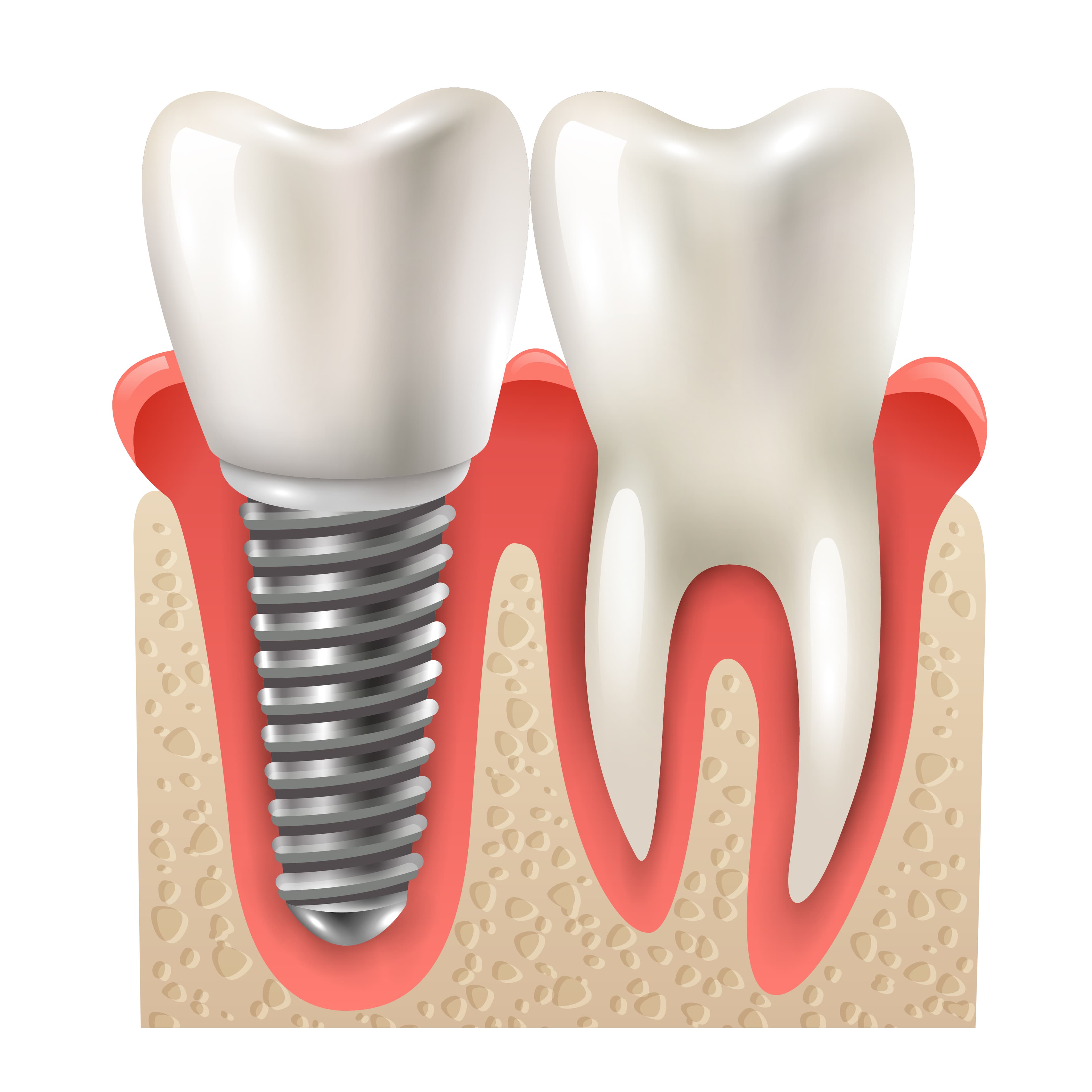 Dental Implants in Ridgewood and Greenpoint: A Practical Guide for Adults Considering Treatment